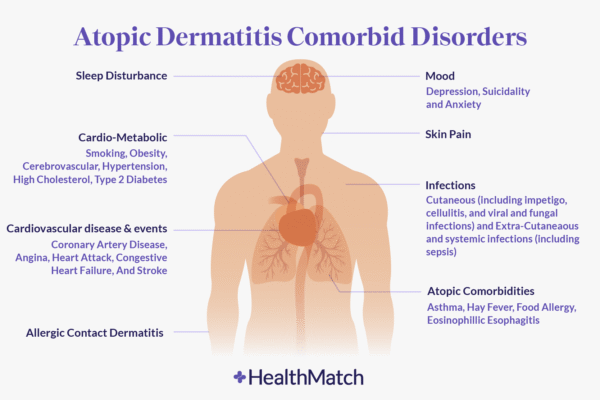 The Mental Health Burden of Atopic Dermatitis