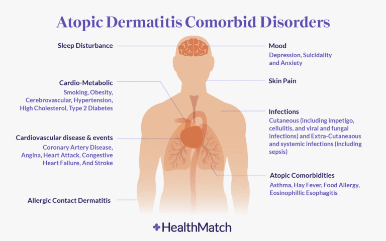 The Mental Health Burden of Atopic Dermatitis