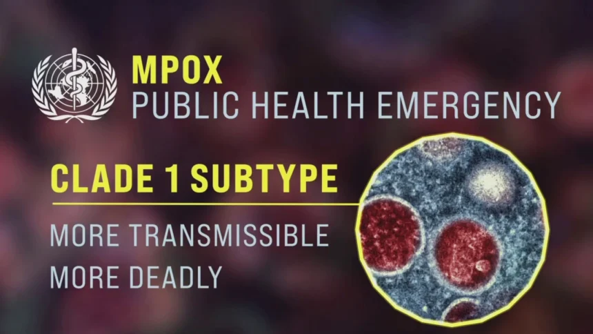 Clade 1 Mpox Virus Found in U.S. Wastewater